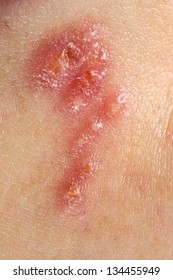 Herpes Simplex On Human Skin