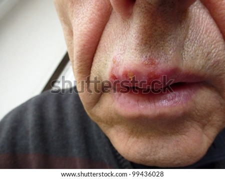 Herpes Simplex Viral Disease Caused By Stockfoto Jetzt Bearbeiten