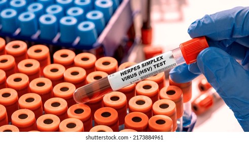 Herpes Simplex Virus (HSV) Test Tube With Blood Sample In Infection Lab