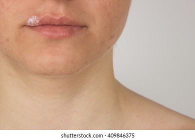 Herpes sore with pus on the lips of a young girl and pimples on the face, a cream for healing on a finger