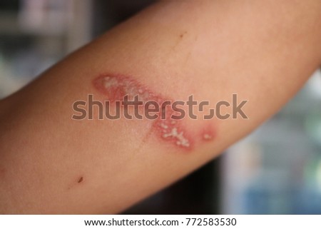 Herpes That Occurs Children Arms Chest Stock Photo Edit Now