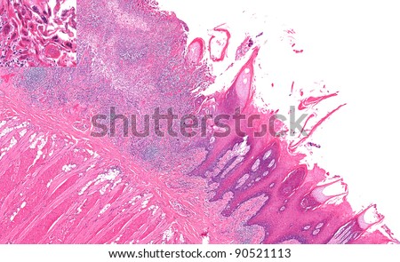 Herpes Ulcer On Tongue Right Bottom Stock Photo Edit Now 90521113