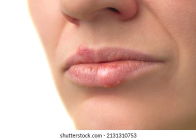 1,339 Swollen lip Images, Stock Photos & Vectors | Shutterstock