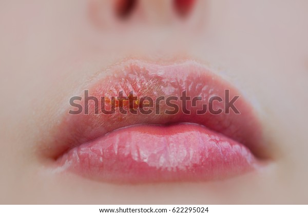 病気の女性の唇のヘルペスウイルス 治療用リップバーム 感染症 感染 女性の病気中の口 皮膚科の疾患と治療 ヘルペスの影響を受けた女性の唇の接写 の写真素材 今すぐ編集