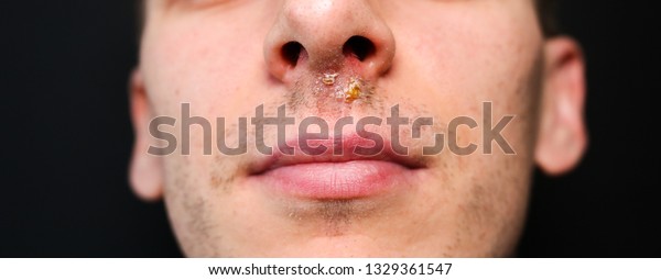 Herpes Virus Under Nose Cold Sore Royalty Free Stock Image