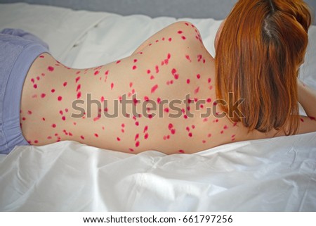 Herpes Women Serious State Health Chickenpox Stock Photo Edit Now