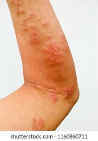Herpes zoster occurs at the human arm. - Shutterstock ID 1160860711