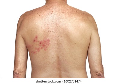 Herpes zoster on the left side of torso on the white background