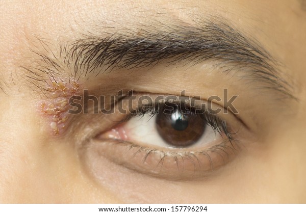 Herpes Zoster Ophthalmicus Eye Herpetic Cold Stockfoto Redigera Nu 157796294