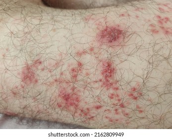 Herpes Zoster Rash In Man Thigh