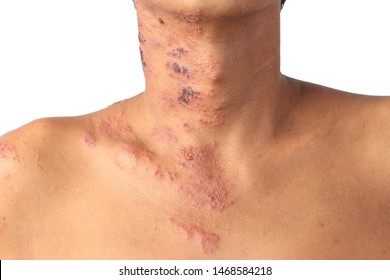 Herpes zoster or Shingles or Zoster; the symtom is infected by Varicella Zoster Virus or VZV.  is a viral disease characterized by a painful skin rash. The rash occurs on body. 
