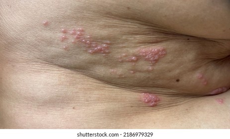 Herpes zoster or shingles viral infection skin .occurs with reactivation of the varicella-zoster virus. painful but self-limited dermatomal rash.Medical concept dermatitis