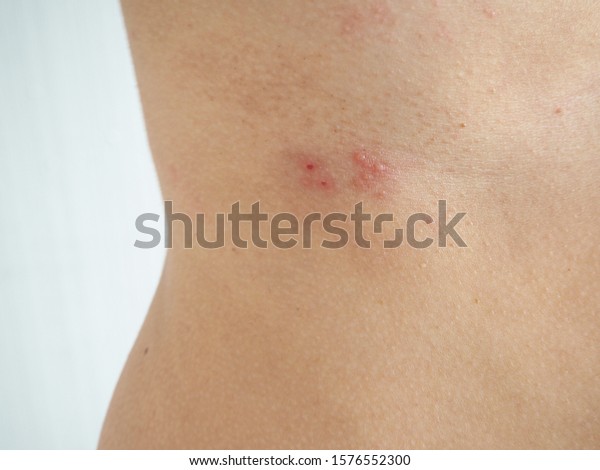 Herpes Zoster Shingles Woman On Her Stockfoto 1576552300 Shutterstock 