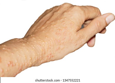 Herpes Zoster Virus On The Arm