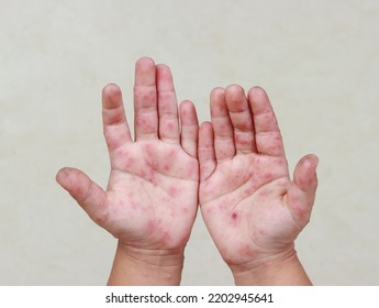 HFMD Rash And Red Blisters On The Body Of A Child Coxsackie Virus