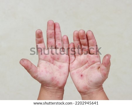 HFMD Rash and red blisters on the body of a child Coxsackie virus