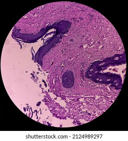 Hidradenoma Papilliferum: Benign Skin Tumor, Rare Benign Neoplasm, Microscopic Show Cyst Wall And Features Of Hidradenoma Papilliferum, Tissue From Labial Cyst.