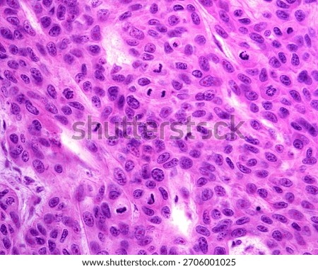 High magnification light micrograph of an epithelial cancer showing several features of malignant cells. The cancerous cells show nuclear atypia, very developed nucleoli, giant nuclei and many mitoses