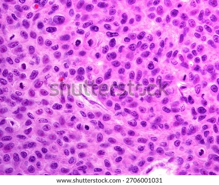 High magnification light micrograph of an epithelial cancer showing several features of malignant cells. The cancerous cells show nuclear atypia, very developed nucleoli, giant nuclei and many mitoses