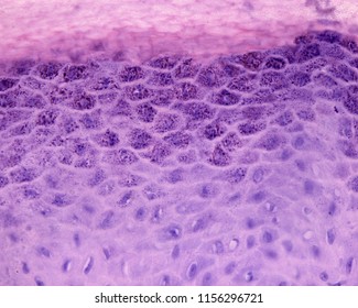 High magnification micrograph of a verruca or plantar wart. The epidermis show an enlarged stratum granulosum (hypergranulosis) and a well-developed stratum corneum (hyperkeratosis).