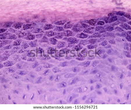 High magnification micrograph of a verruca or plantar wart. The epidermis show an enlarged stratum granulosum (hypergranulosis) and a well-developed stratum corneum (hyperkeratosis).