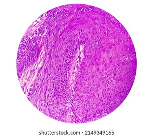 High Magnification Of Skin Cells Infected With The HPV Virus. Common Wart. Verruca Vulgaris. Microscopic View.