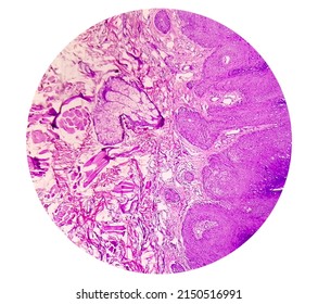 High Magnification Of Skin Cells Infected With The HPV Virus. Common Wart. Verruca Vulgaris. Microscopic View.