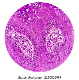 High Magnification Of Skin Cells Infected With The HPV Virus. Common Wart. Verruca Vulgaris. Microscopic View.