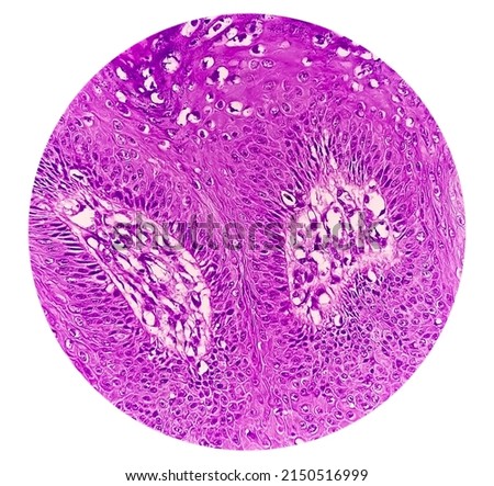 High magnification of skin cells infected with the HPV Virus. Common Wart. Verruca vulgaris. Microscopic view.