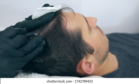 High Quality Close-up Of A Man Laying On A Couch During The Esthetician Hair Treatment. Male Tricopigmentation Service. Scalp Micropigmentation Treatment.