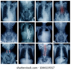 Similar Images, Stock Photos & Vectors of X-Ray Image Of Human Chest