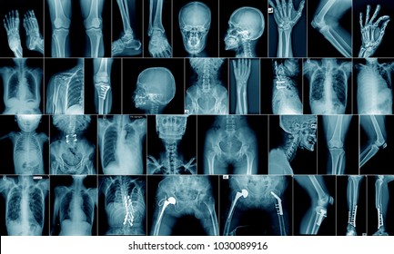 high quality x-ray collection body part and fracture area - Shutterstock ID 1030089916