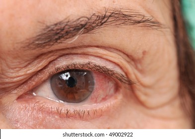 High resolution macro photo of an infected female eye