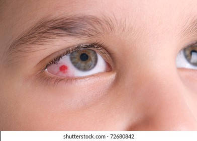 High resolution macro photo of an infected eye of a child.