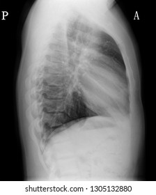 High Resolution Normal Lateral Chest Xray Stock Photo 1305132880 ...