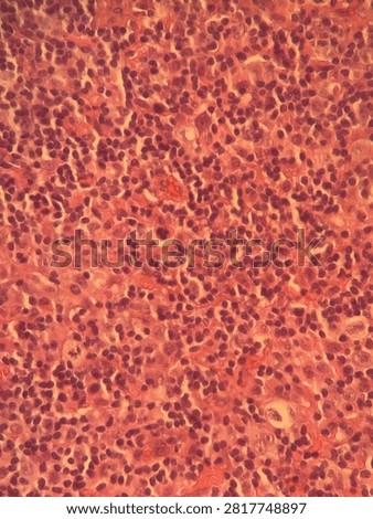 High-power microscopic histopathology section of cellular tissue infiltrate with H and E stain.