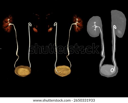 High-resolution 3D CT image showing the kidney with an indwelling ureteral stent in place.
