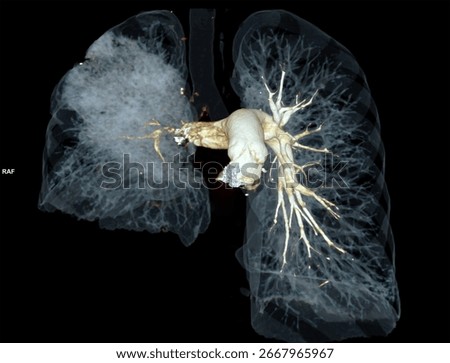 High-resolution 3D CT scan showing right pulmonary artery embolism with bronchi structures. Ideal for medical, radiology, and educational purposes.
