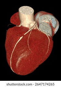 High-resolution 3D CTA image of the human heart showing left anterior descending (LAD) artery blockage with complete coronary artery anatomy.
 Useful for cardiology, diagnostics, and education.