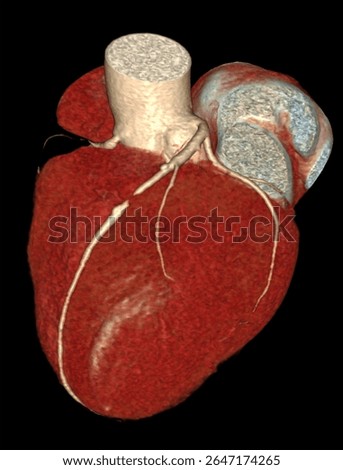 High-resolution 3D CTA image of the human heart showing left anterior descending (LAD) artery blockage with complete coronary artery anatomy.
 Useful for cardiology, diagnostics, and education.