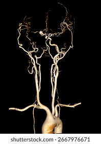 High-resolution 3D CTA image of neck and cerebral vessels showing right posterior cerebral artery aneurysm and right internal carotid artery. 
Ideal for medical and educational use.
