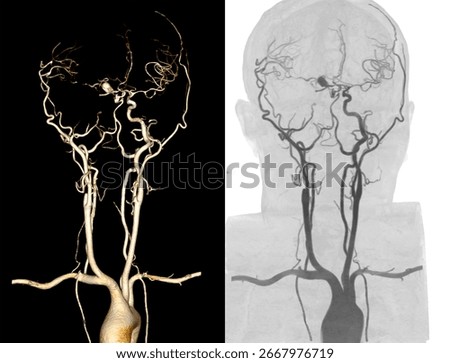 High-resolution 3D CTA image of neck and cerebral vessels showing right posterior cerebral artery aneurysm and right internal carotid artery. 
Ideal for medical and educational use.