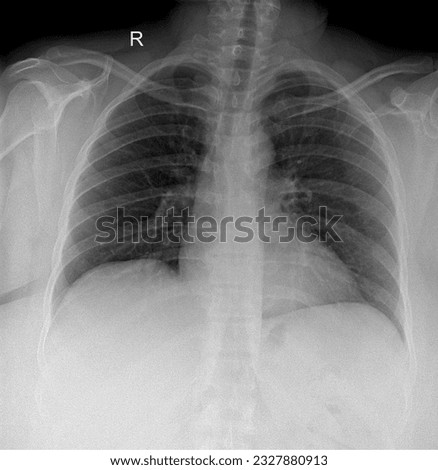 High-resolution chest X-ray capturing the thoracic region, revealing the ribs, sternum, and mediastinal structures, providing insights into respiratory and cardiovascular health.