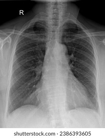 High-resolution chest X-ray image showing the anatomy of the lungs and ribcage.