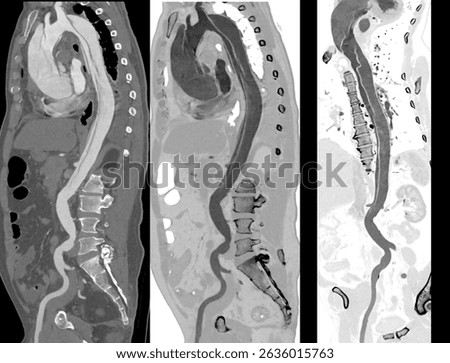 High-resolution CT scan highlighting aortic dissection with tracing carve technique.
 Perfect for cardiology diagnostics, vascular research, and medical education focused on arterial pathologies.