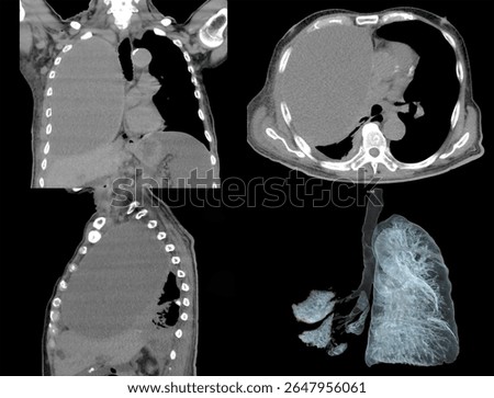 High-resolution CT scan image showing partial or complete lung collapse and revealing reduced lung volume and shift of mediastinal structures. 