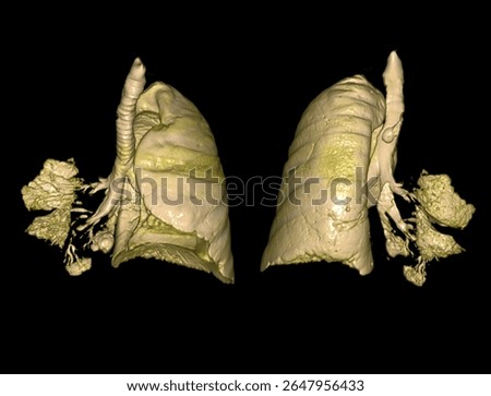 High-resolution CT scan image showing partial or complete lung collapse and revealing reduced lung volume and shift of mediastinal structures. 