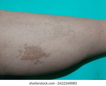 A high-resolution photograph capturing the unique pattern of a natural birthmark. Ideal for use in artistic projects, character design references, or dermatological studies