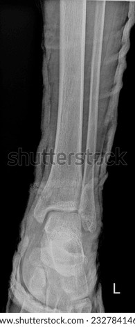 High-resolution X-ray of the human ankle joint, displaying the tibia, fibula, talus, and calcaneus, allowing for accurate assessment of ankle fractures