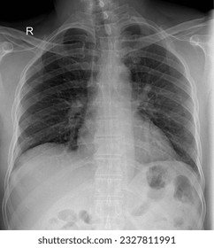High-resolution X-ray image of the chest revealing the thoracic anatomy, including the ribcage and lungs